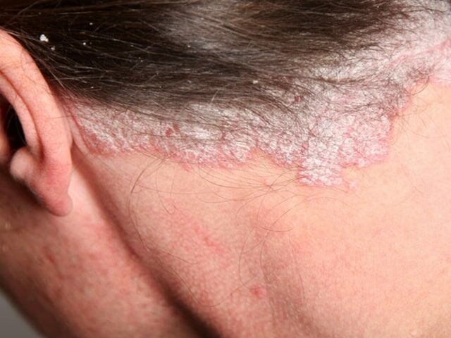 a fejbőr kezelésének pustuláris pikkelysömörét