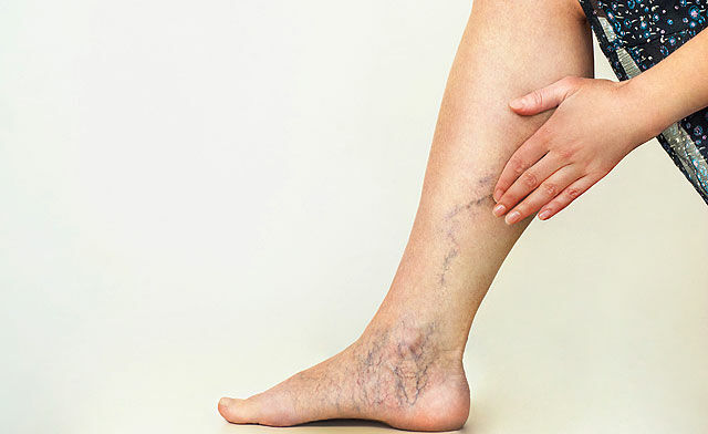 a lábak pikkelysömörének kezelése