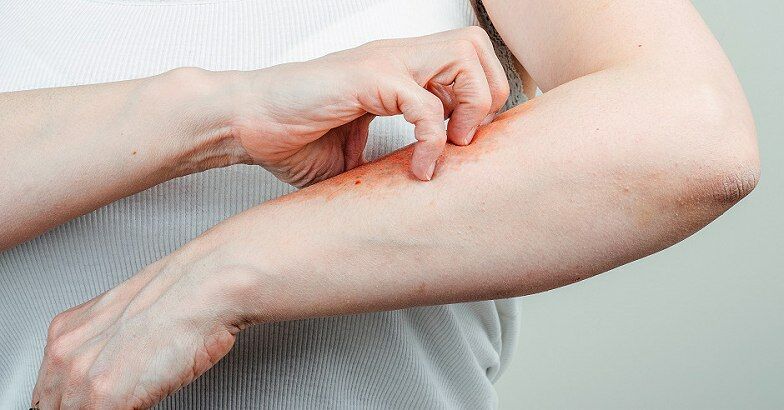 kezdeti stádiumú pikkelysömör otthoni kezelés vörös foltok a testen és viszketés hogyan kell kezelni