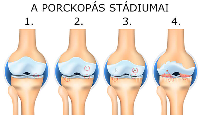 A porckopás stádiumai.