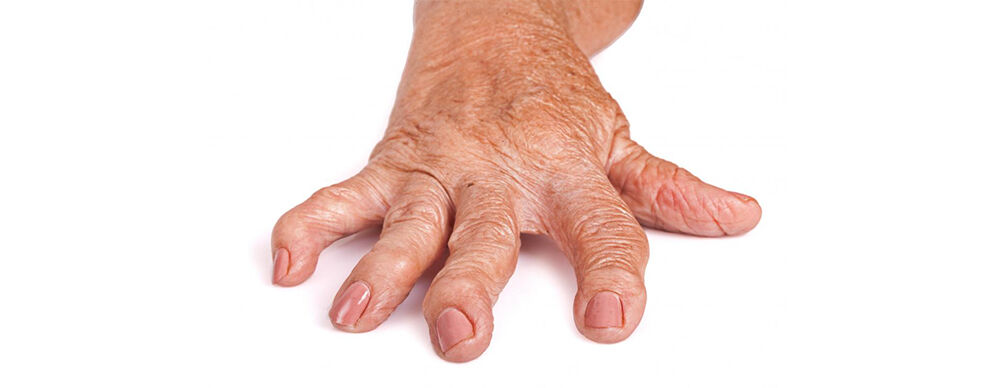 A rheumathoid arthritisról.