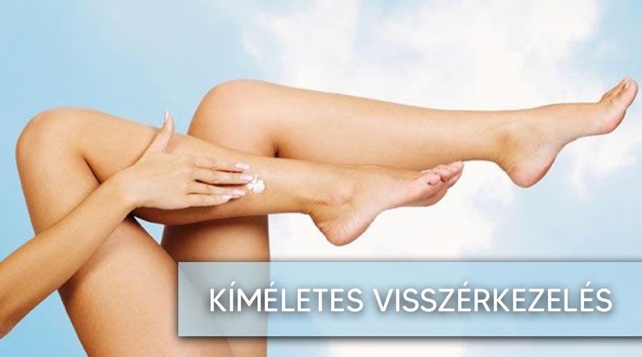 Visszérkezelés kíméletesen