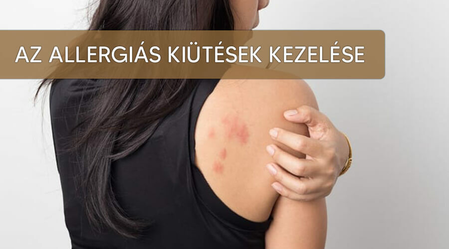 Az allergiás kiütések kezelése.