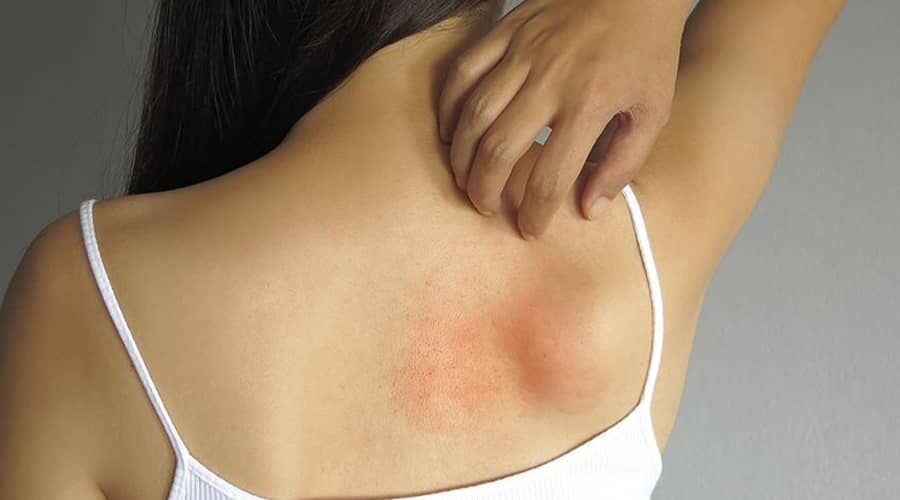 Allergiás kiütés a bőrön
