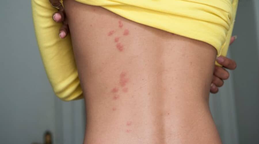 Allergiás tünetek a háton