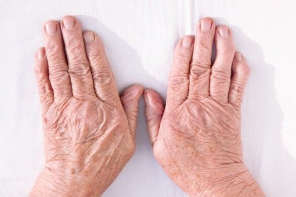 térd artroso artritisz tünetei és kezelése