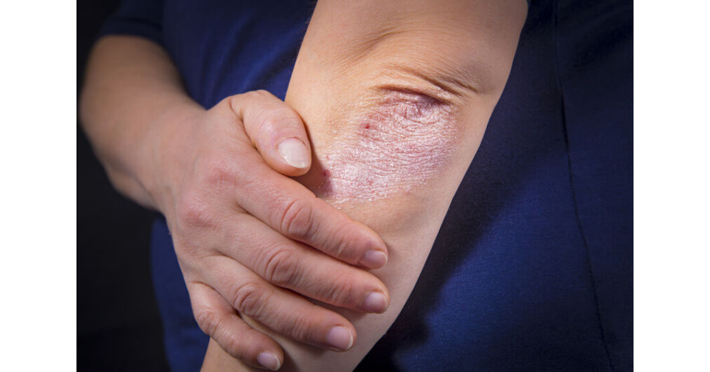 pikkelysömör kezelése színterápiával bőrkiütés vörös foltok formájában a hónalj alatt