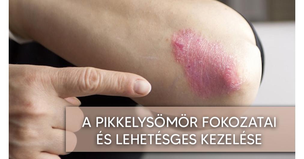 lemezes pikkelysömör köröm