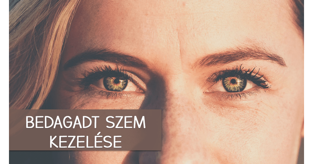 Szemhéjgyulladás | BENU Gyógyszertár