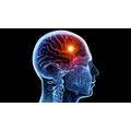 Miről ismerhetjük fel a stroke-ot?