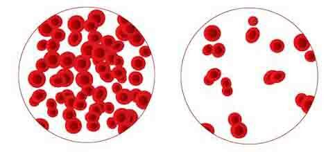 Vörös vérsejtek vérszegény állapotban