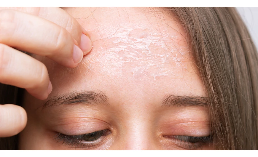 Pikkelysömör, ekcéma, dermatitis? 5 azonnali tipp a viszketés enyhítésére!