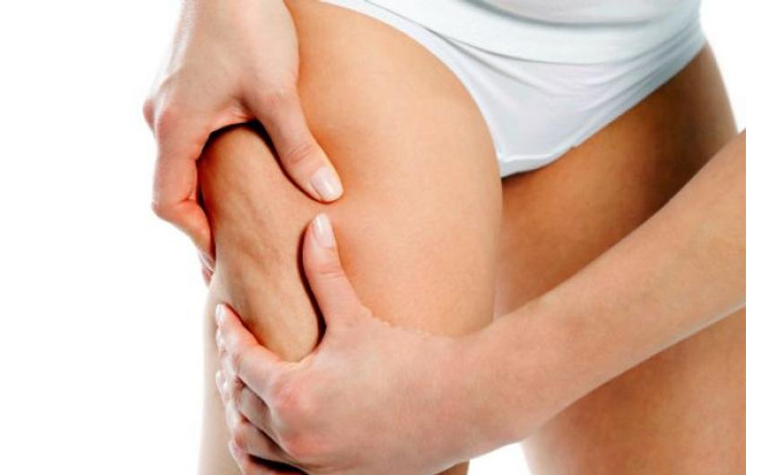 5 tuti tipp a narancsbőr legyőzésére