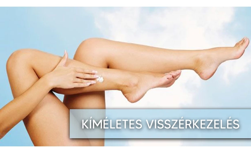 ​Visszérkezelés kíméletesen, a természet erejével