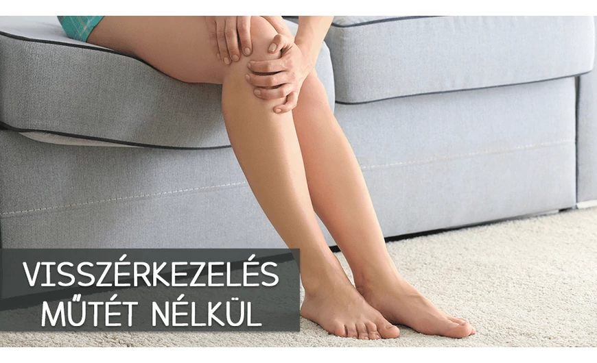 Visszérkezelés: nem csak műtéttel lehetséges!