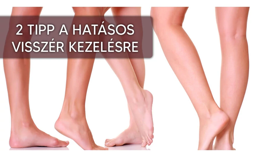 2 TIPP VISSZÉR KEZELÉSÉRE