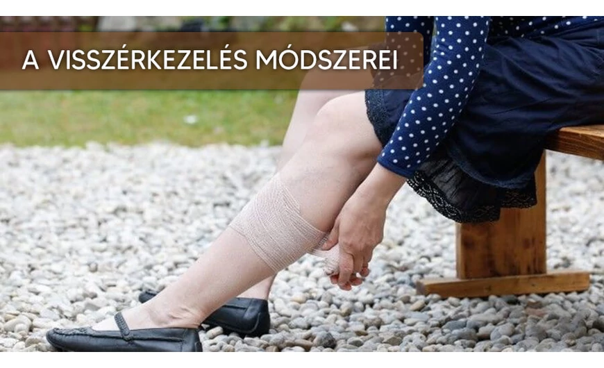 ​Mit kell tudnia visszérkezelés módszereiről?