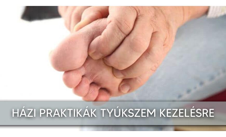 Tyúkszem elleni módszerek | Tyúkszem kezelése