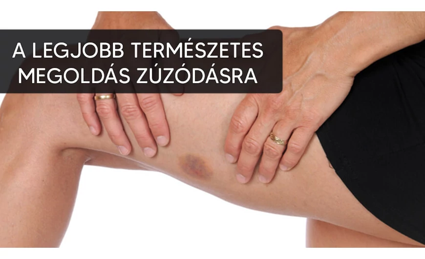 A legjobb természetes megoldás zúzódásra