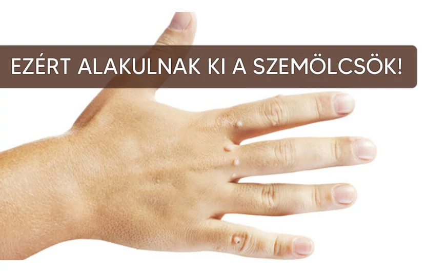 Mitől alakulnak ki a szemölcsök?
