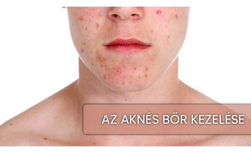 Az aknés bőr kezelése.