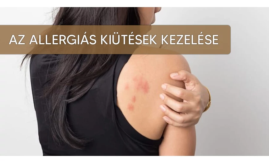 Az allergiás kiütések kezelése