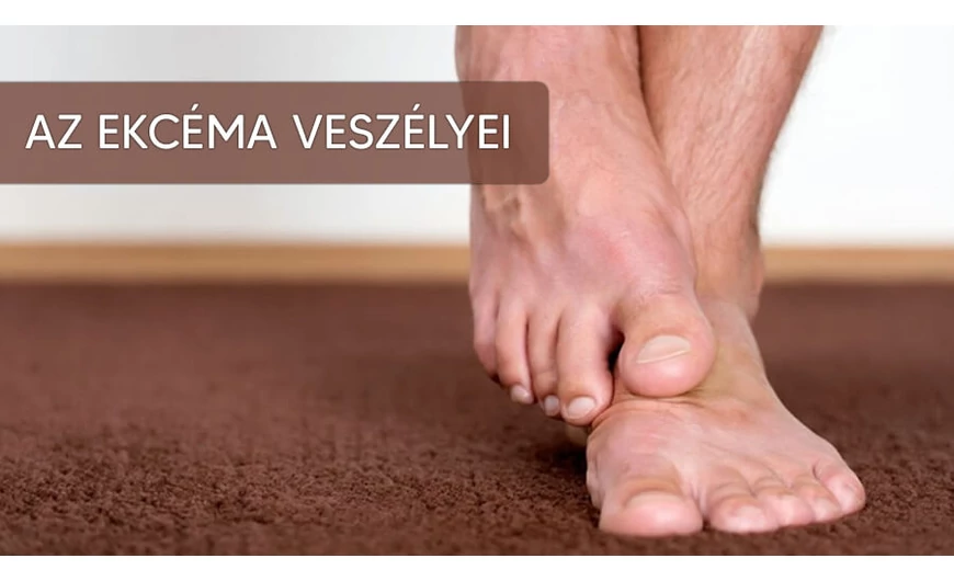  Az ekcéma veszélyei: létezik végleges kiút?