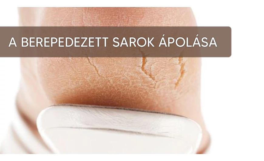 A berepedezett sarkak ápolása