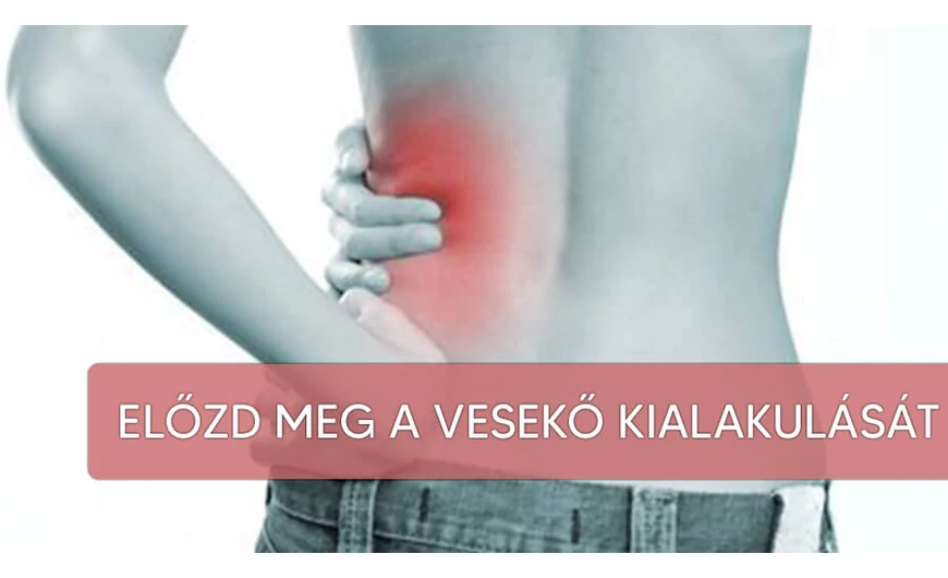 Mivel előzhetjük meg a vesekő kialakulását?