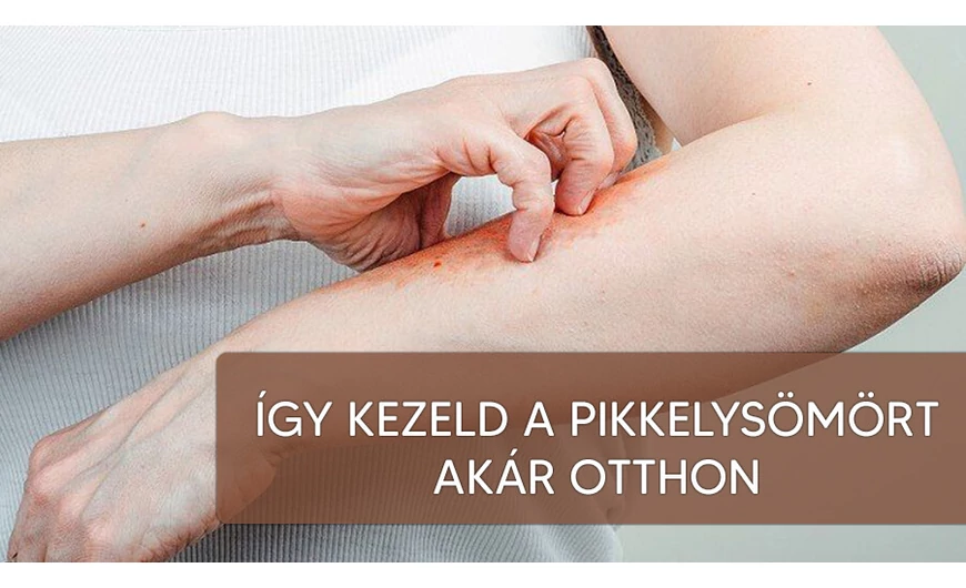 Így kezeld a pikkelysömört akár otthon!