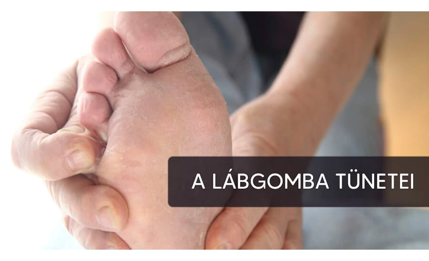 Tipikus nyári betegség a lábgomba
