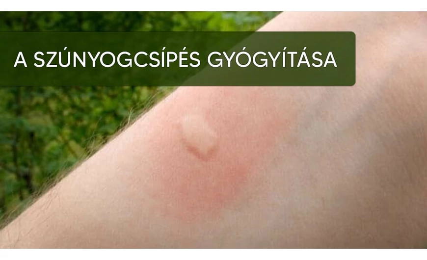 Szúnyogcsípések gyógyítása és elkerülése hatékonyan