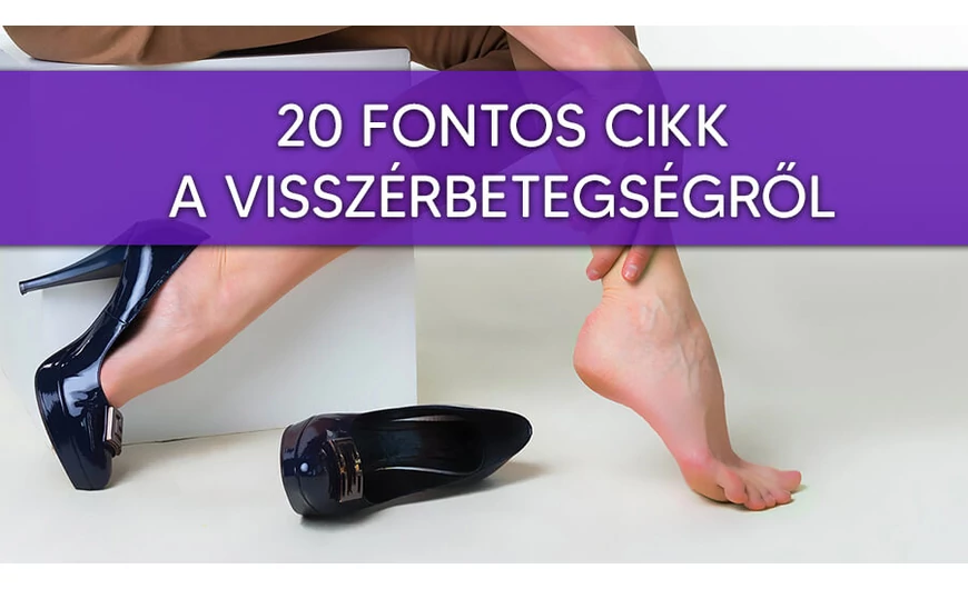 20 fontos cikk a visszérbetegségről