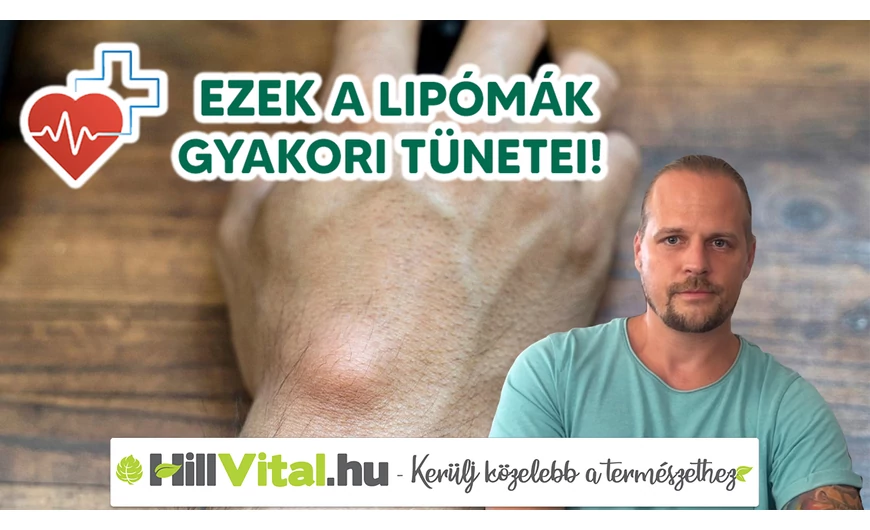 Dr. Kiss Csaba: „Ezek a lipómák gyakori tünetei!”