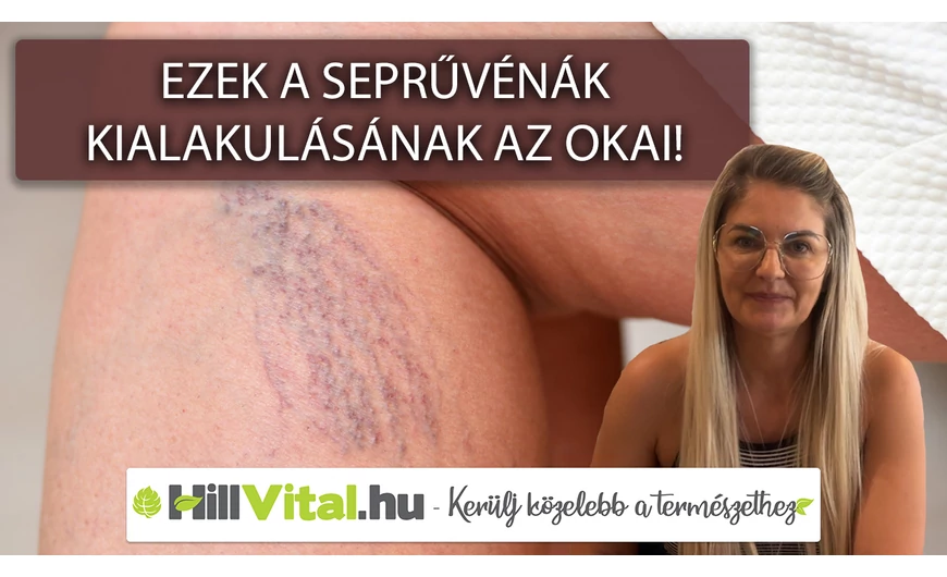 Ezek a seprűvénák kialakulásának az okai!