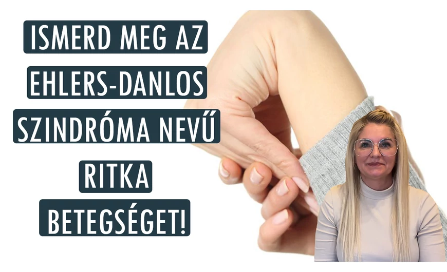 Az ehlers-danlos szindróma tünetei és kezelése