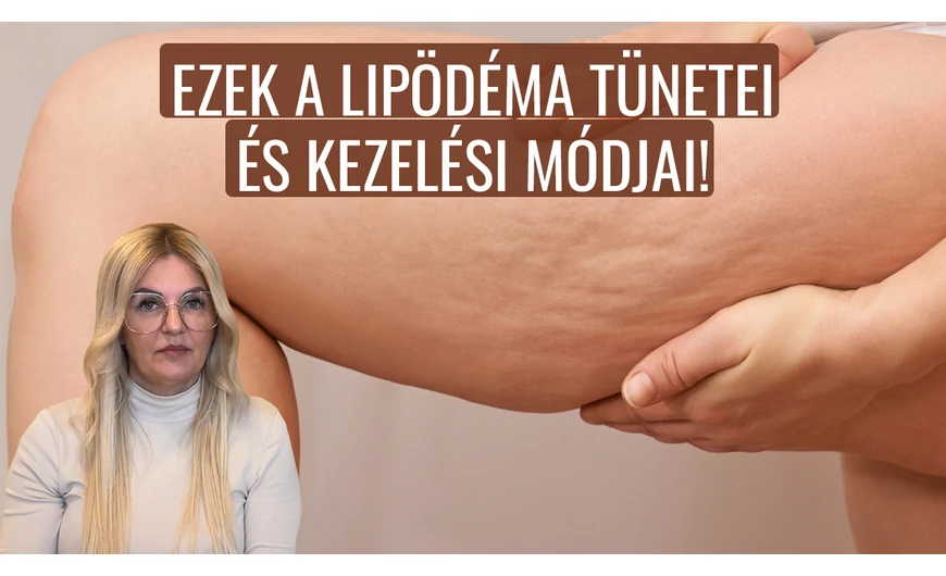 Ezek a lipödéma tünetei és kezelési módjai!