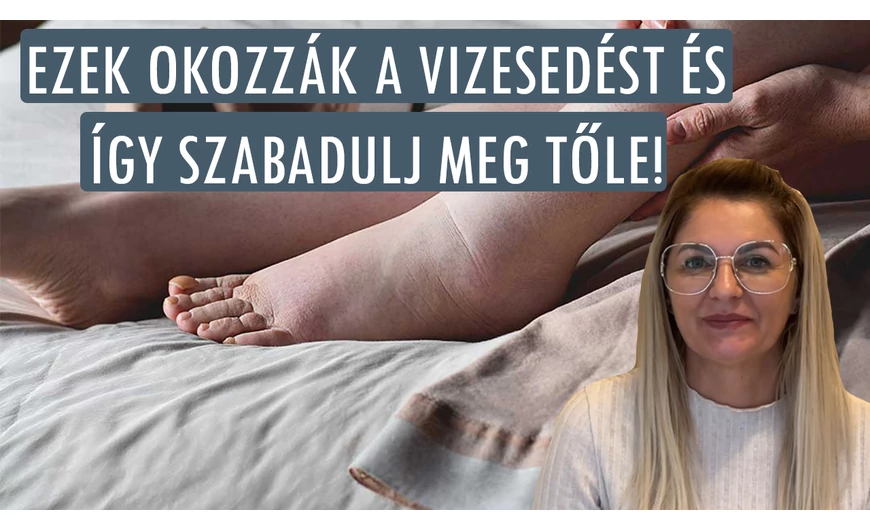 Ezek okozzák a vizesedést és így szabadulj meg az ödémától!