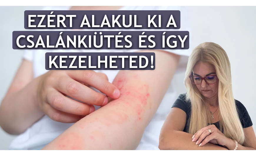 Ezért alakul ki a csalánkiütés és így kezelheted!