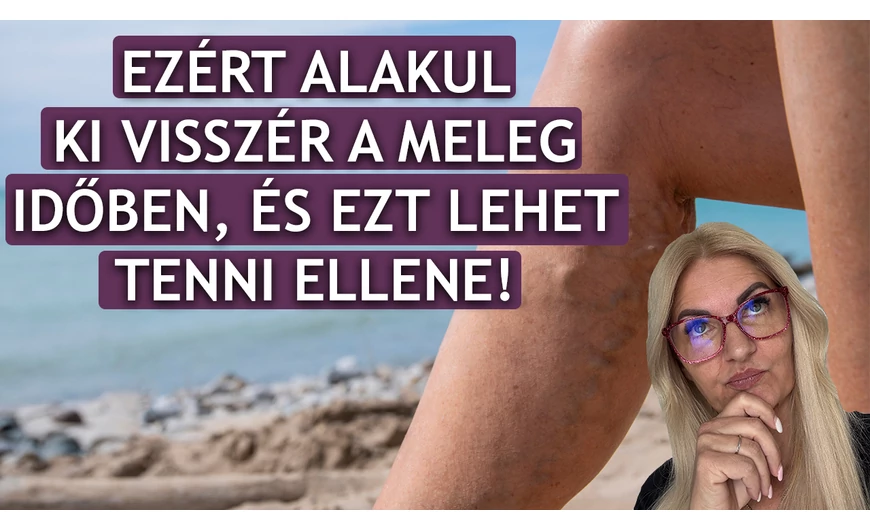 Ezért alakul ki visszér a meleg időben, és ezt lehet tenni ellene!
