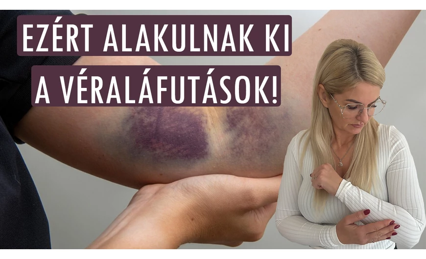 Kék, zöld, lila foltok a bőrön: ezért alakulnak ki a véraláfutások