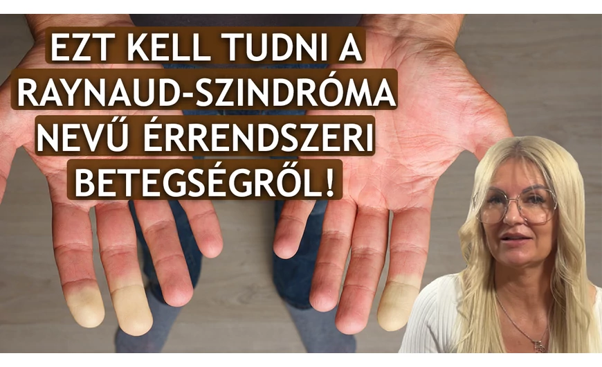 Ezt kell tudni a raynaud-szindróma nevű érrendszeri betegségről!