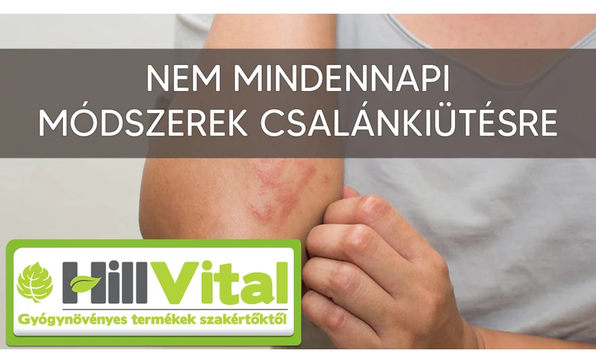7 meglepő módszer csalánkiütés ellen