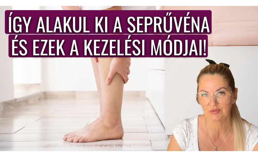 Így alakul ki a seprűvéna és ezek a kezelési módjai!
