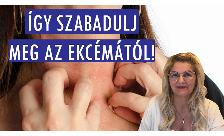 Így szabadulj meg az ekcémától: 5 hatékony tipp az enyhítésre