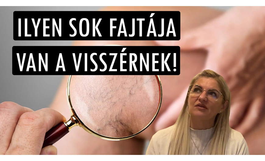 Ezt tudnod kell: ilyen sok fajtája van a visszérnek!