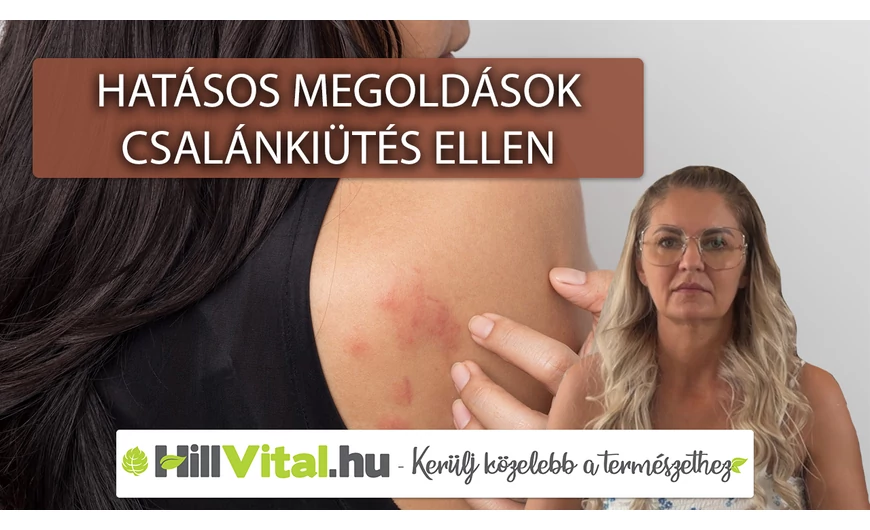 Ezt tedd, hogy minél gyorsabban elmúljon a csalánkiütés!