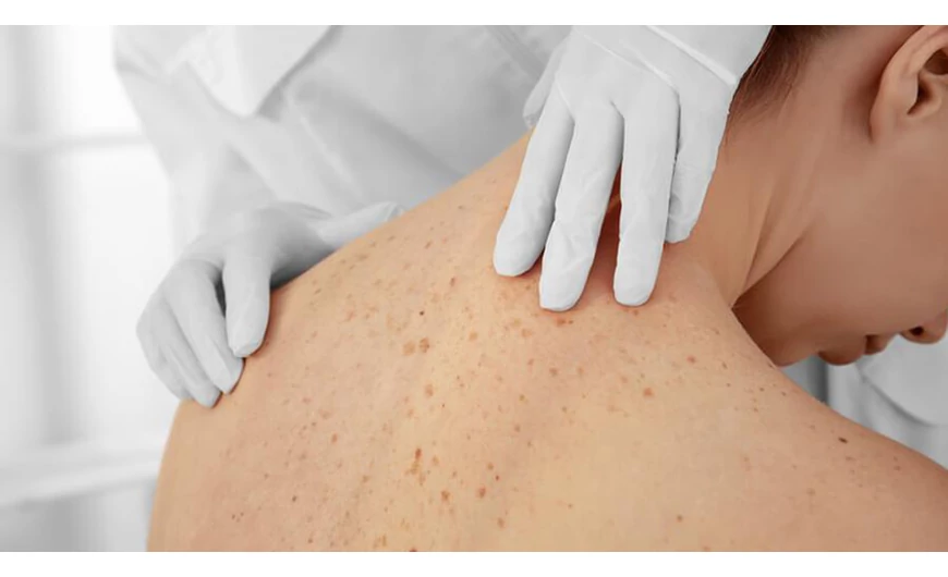 A nyár legnagyobb veszélye a melanoma!