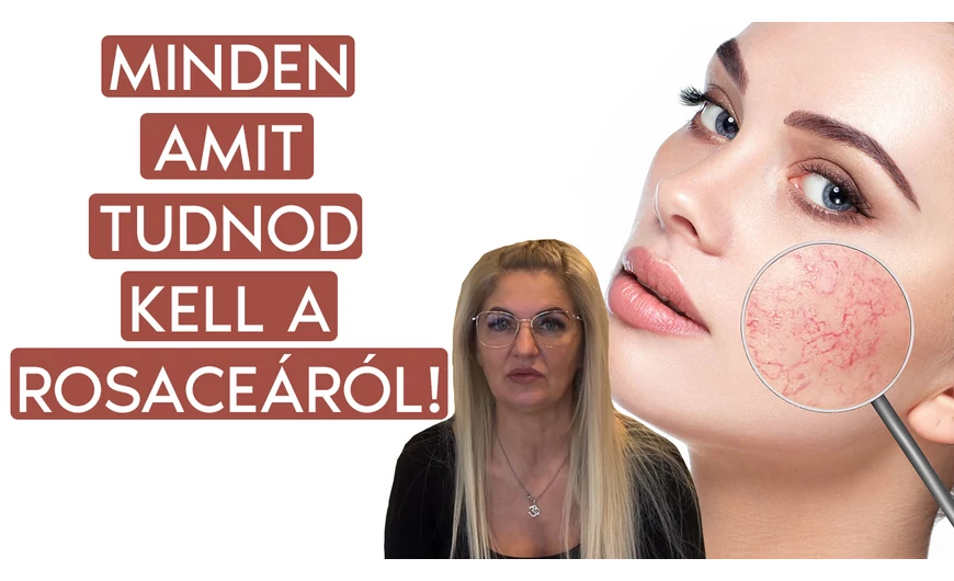 Rosacea: Tünetek, Okok és Kezelési Lehetőségek