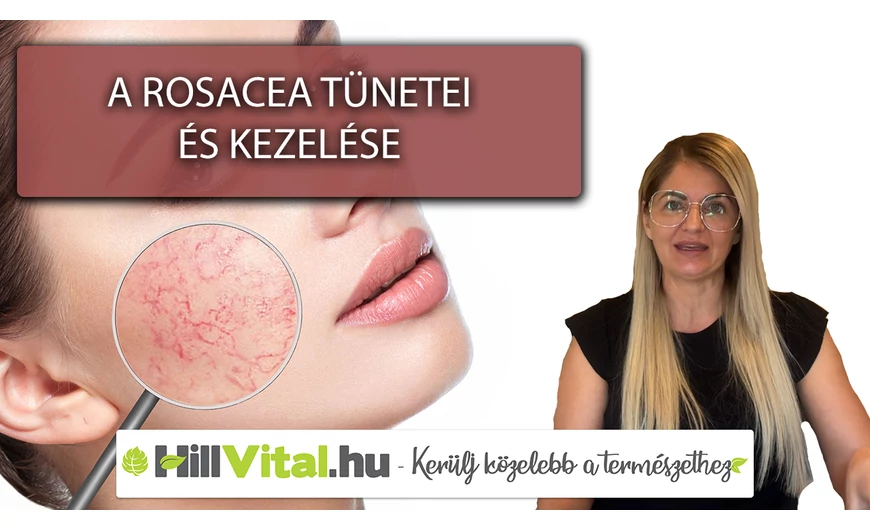 Ezek a rosacea tünetei és kezelési módjai!